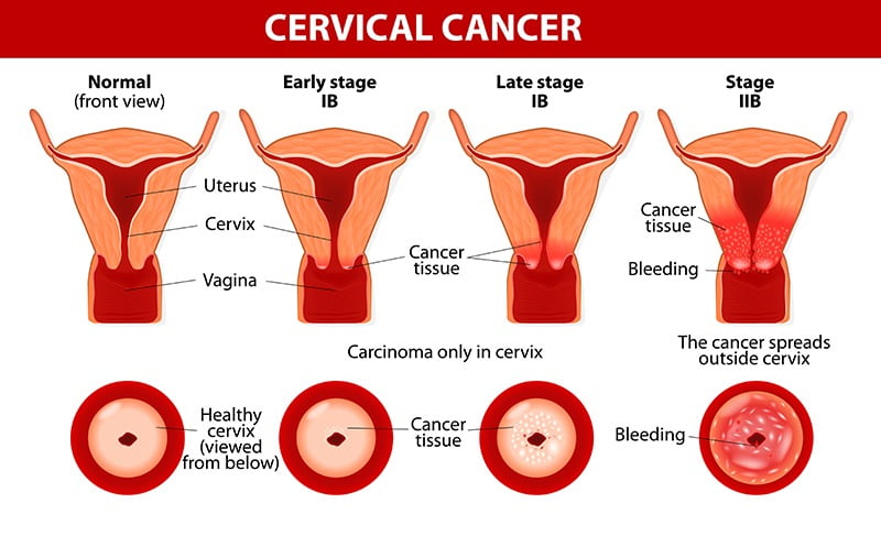 cervical cancer treatment surgery bangalore